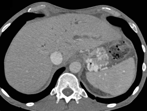 Varices And Portal Hypertension In Patient With Chronic Pancreatitis