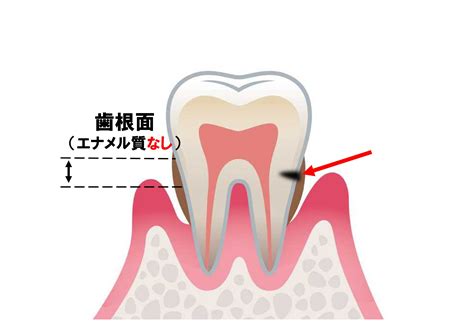 2019 12 23 むし歯と歯周病の新しい関係 西辻歯科医院