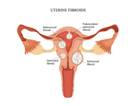how to get rid of fibroids effective home remedies