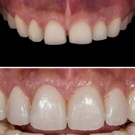 Carillas Dentales De Porcelana Clínica I Blú Dental