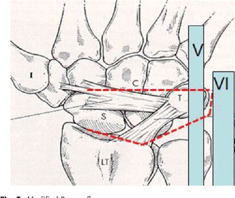 Pdf Scapholunate Ligament Reconstruction Semantic Scholar