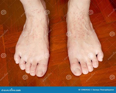 An Itchy Skin Rash On Woman`s Feet Stock Photo