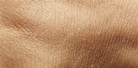 Mallinckrodts Lab Grown Skin As Good As Skin Grafts For Burns