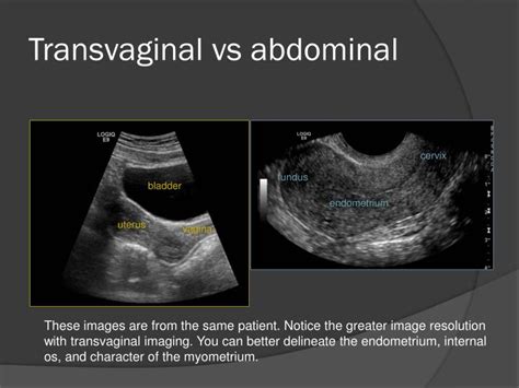 Ppt Transvaginal Ultrasound Powerpoint Presentation Id2022803