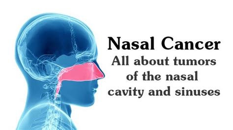 Nasal Cancer All About Tumors Of The Nasal Cavity And Sinuses Wikijunkie