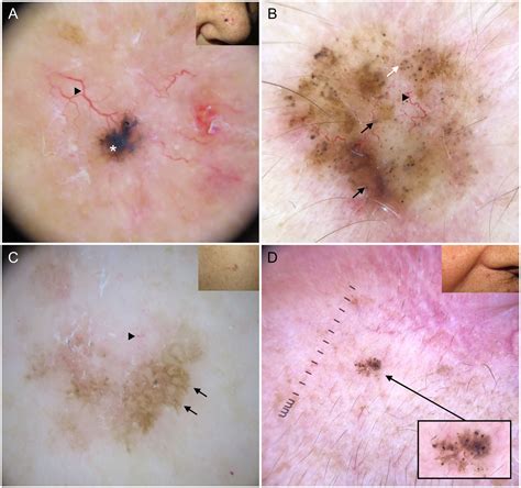 Dermoscopy In Basal Cell Carcinoma An Updated Review Actas Dermo