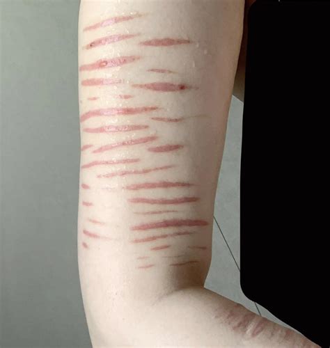 Does Anyone Feel More Ashamed About Showing Their Scars Because They