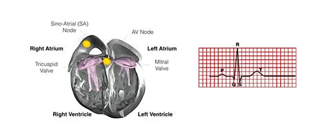 Defibrillator Aicd Implantation One Heart Cardiology