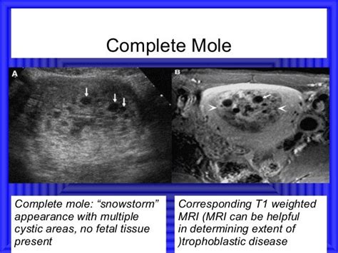 Complete Mole Diagnostic Medical Sonography Diagnostic Medical