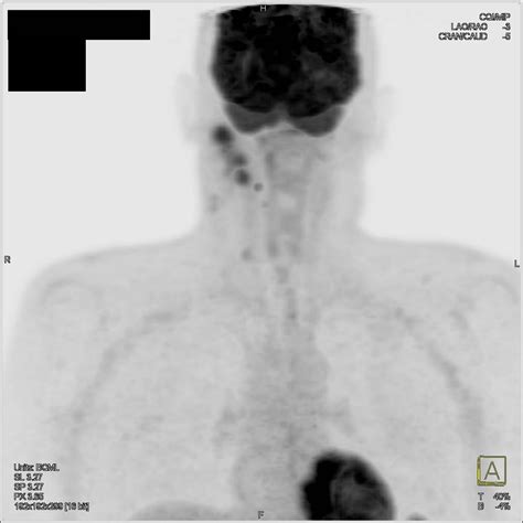 Adenopathy In Left Neck In Head And Neck Tumor Recurrence Ctpet Case