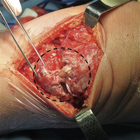 Download this premium vector about diagram showing tendon injury, and discover more than 12 million professional graphic diagram showing tendon injury premium vector. Patient supine, left leg. Under anesthesia, the patellar ...