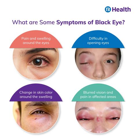 Black Eye Causes Symptoms Home Remedies And Diagnosis
