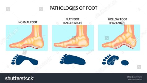 Foot Pathologies Normal Flat Hollow Foot Stock Vector Royalty Free