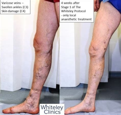 Huge Varicose Veins Treated With Endovenous Surgery The Whiteley Clinic