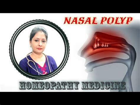 Nasal Polyps Homeopathy Medicine Youtube