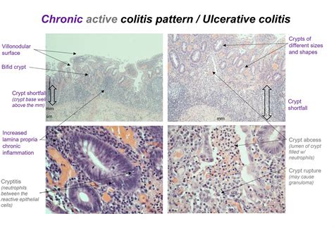 Pathology Outlines Ulcerative Colitis