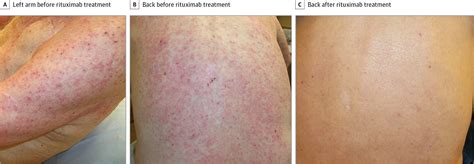 Rituximab Treatment For Recalcitrant Dermatitis Herpetiformis Allergy