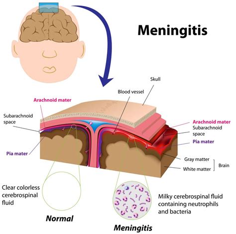 Meningitis Symptome Ursachen Und Behandlung Der Hirnhautentzündung