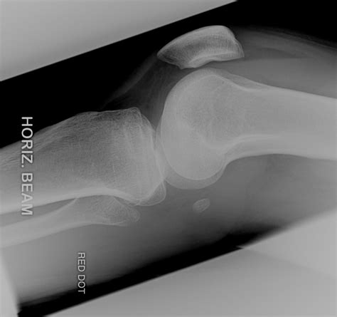 Tibial Plateau Fractures - Core EM