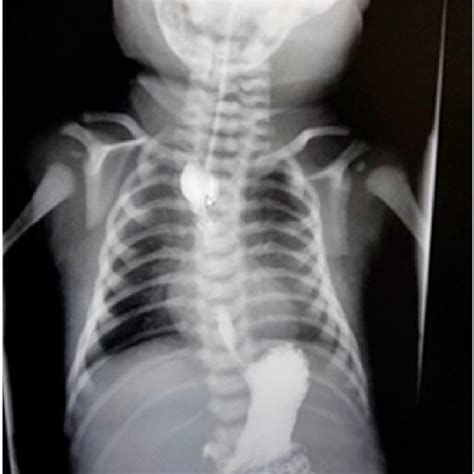 Classification Of Esophageal Atresia Tracheoesophageal Fistula A