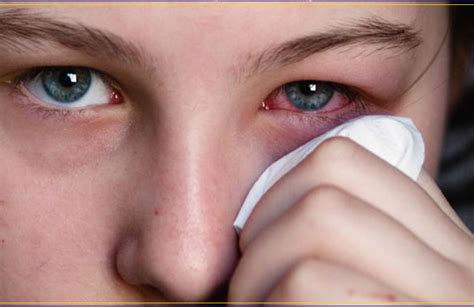 Conjunctivitis Symptoms Causes And Treatment