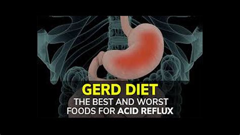 What Are The 7 Best And Worst Foods For Acid Reflux