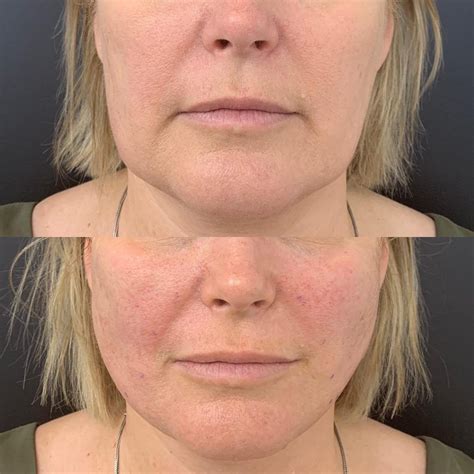 Jowls Restore Your Jawline With Jaw Fillers For Sagging Jowls Jowl