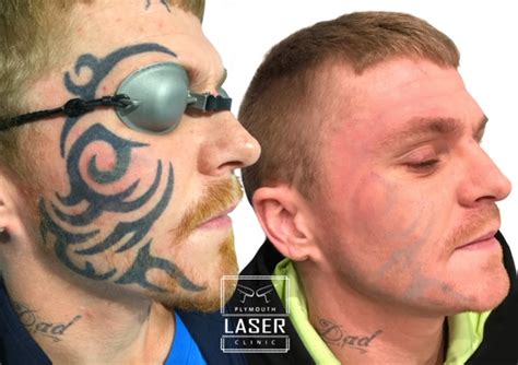 Laser Tattoo Removal Whiteroom Laser Ltd
