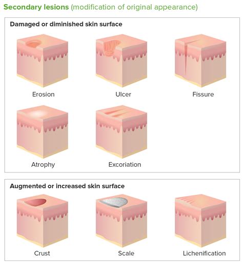 Secondary Skin Lesions Concise Medical Knowledge