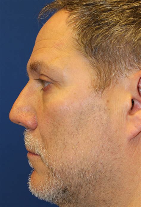 Troy Male Cosmetic Rhinoplasty Before And After Photos Michigan