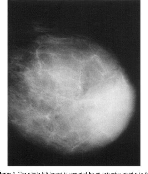 Figure 1 From Scintimammographic Findings Of Phyllodes Tumor Of The