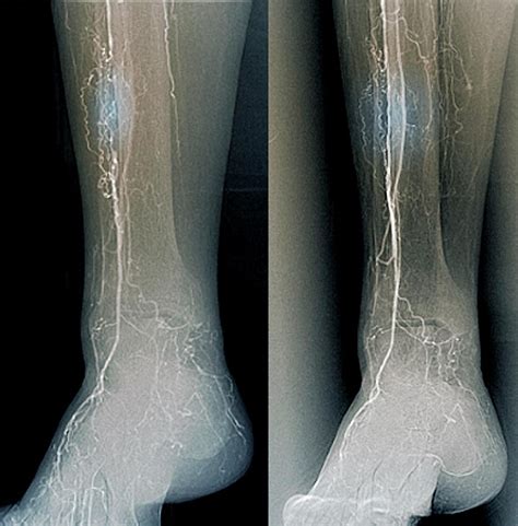 Treatment For Blocked Leg Arteries Photograph By Zephyrscience Photo