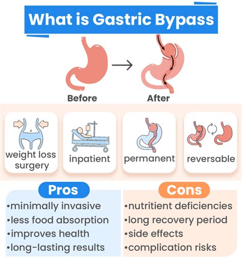 Gastric Bypass Surgery How It Works Benefits And Drawbacks