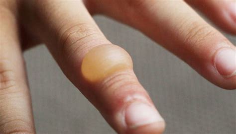 Burn Blister First Aid Treatment And Types Of Burns