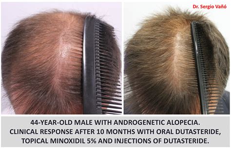 Alopecia Androgénica Masculina Hombres Causas Solucion Problema