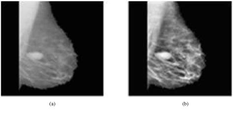 Figure 4 From Classification Of Normal And Abnormal Mammograms Based On