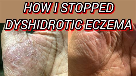 How I Stopped Dyshidrotic Eczema On My Palms Fingers And Hands Youtube
