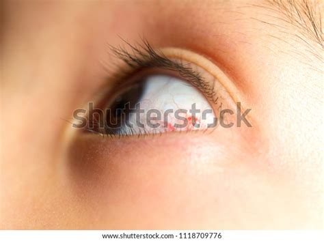 Boy Burst Blood Vessel Eye Closeup Stock Photo 1118709776 Shutterstock