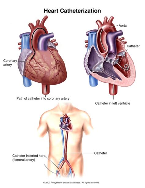 Inferior Vena Cava Cancer ModernHeal Com