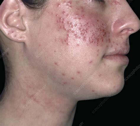 Eczema Herpeticum Stock Image C0529794 Science Photo Library
