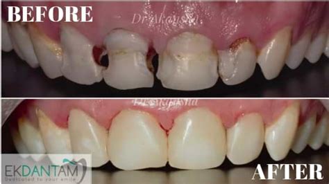 Direct Composite Restorations Jaipur Dental Implants