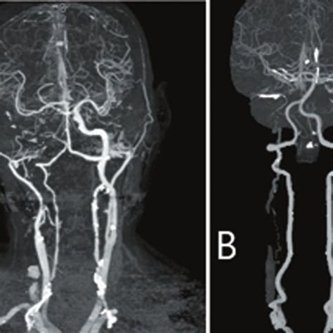 CT Angiography CTA Demonstrates Severe Carotid Artery Occlusion