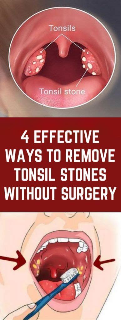 How To Remove Tonsil Stones In Back Of Throat Howtormeov