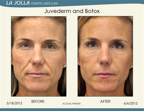Patient Treated With Juvederm And Botox At La Jolla Cosmetic Laser