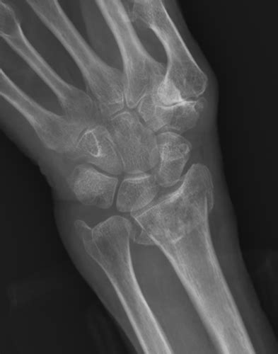 Wrist Fracture Surgery And Treatment Cape Town