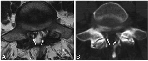 Long Term Effectiveness Of Direct Ct Guided Aspiration And Fenestration