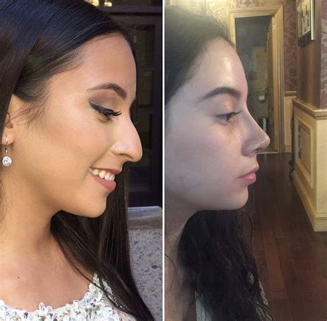 Pin By Rodriguez Laetitia On Nez Rhinoplasty Nose Jobs Nose Surgery