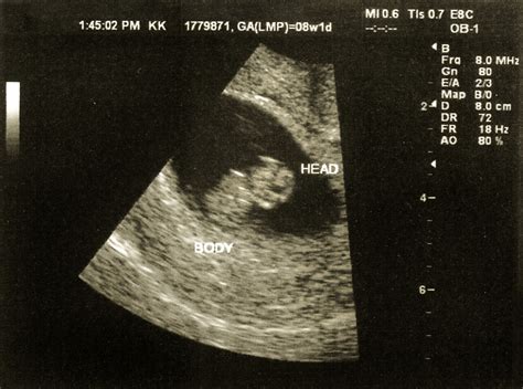8 Weeks Pregnant Ultrasound Ultrasound At 8 Weeks 4 Days Ever