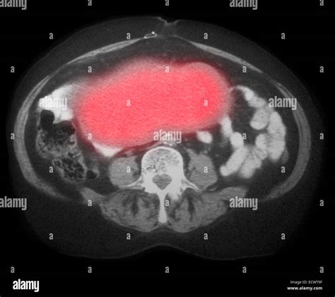 Ovarian Cancer On Ct Scan Stock Photo 76785227 Alamy