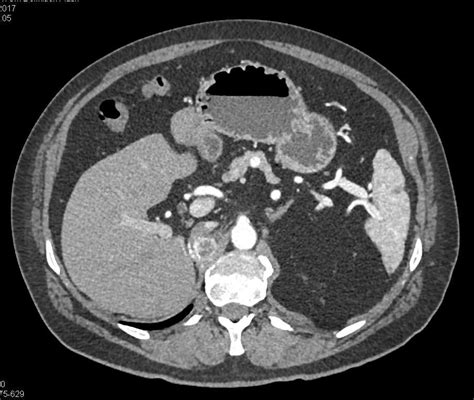 Metastatic Renal Cell Carcinoma To Adrenals And Lung Adrenal Case